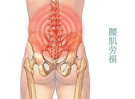 腰骶疼痛