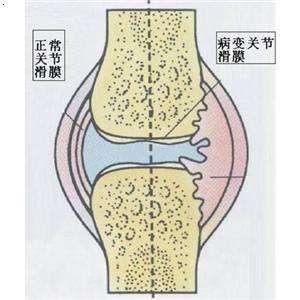 膝关节肿大