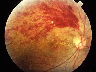 视网膜出血
