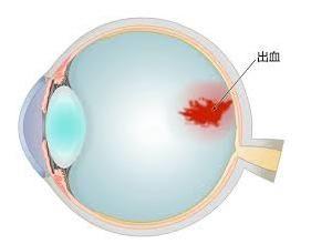 视网膜出血