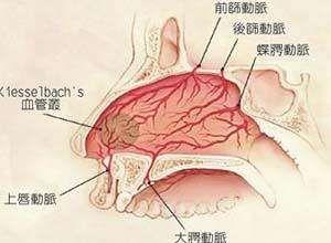 鼻腔前部出血