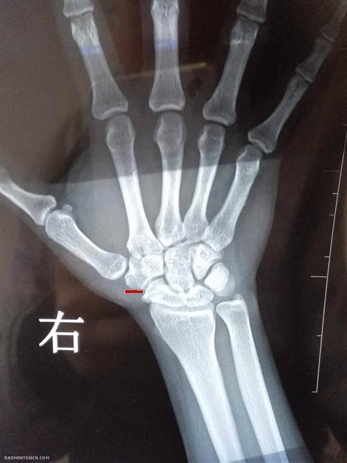 手腕长骨刺