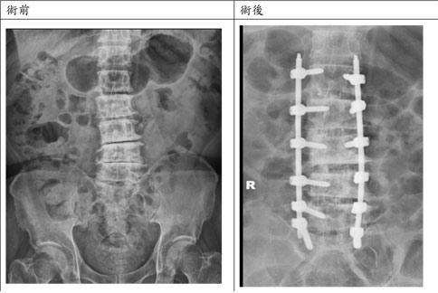 腰椎退化