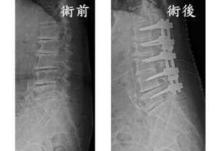腰椎退化