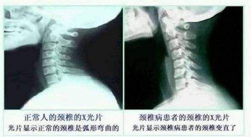 颈椎变形