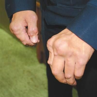 手指痛风