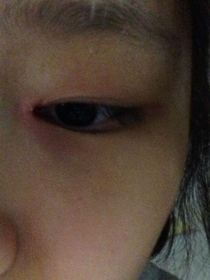 烂眼边