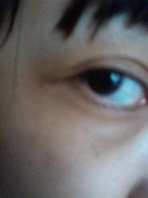 烂眼边