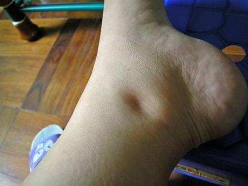 腿脚浮肿