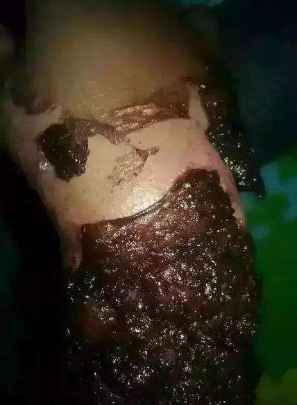 难治性溃疡