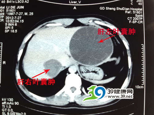 CT造影显示李先生的肝左叶已经几乎被包虫囊占满