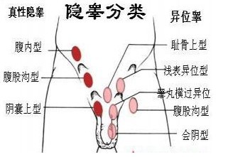 單側隱睪手術後下降的睪丸功能正常嗎?_單側隱睪