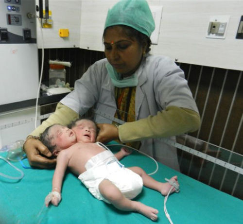 印度孕妇产下双头连体女婴 存活可能性低(图)