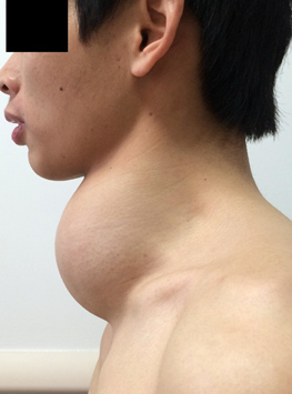 暨大附一院甲状腺外科切除巨大甲状腺肿瘤