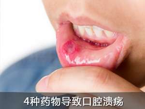 口腔溃疡 祸首是药物？