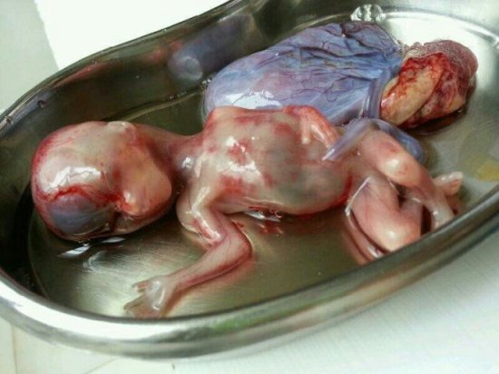 六个月堕胎的胎儿图片图片