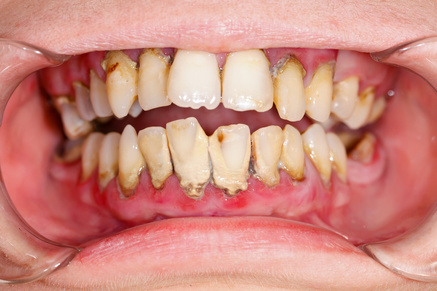真實還原種植牙修復過程