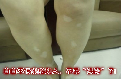 色素脱失斑容易治疗吗 org_726845.jpg