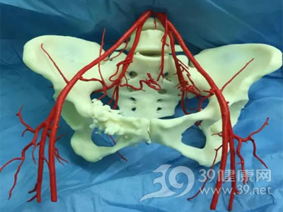 珠江医院3D打印切除骨盆巨瘤