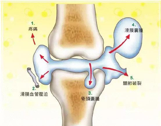 滑膜炎:膝盖疼得像中了箭!破除它的妙招在这里!