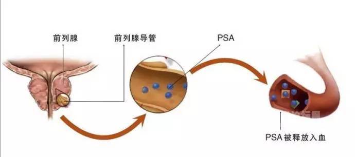 腰痛贴膏药不管用？小心前列腺癌