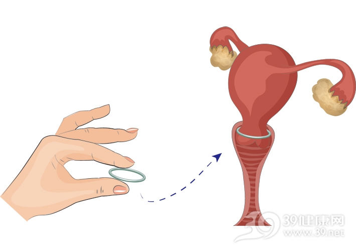 到子宫里着床生长,而上环的原理就是阻断胚胎在子宫内着床的这一步骤