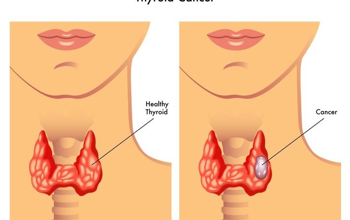 得了甲状腺癌身体会发出4个信号误诊率很高