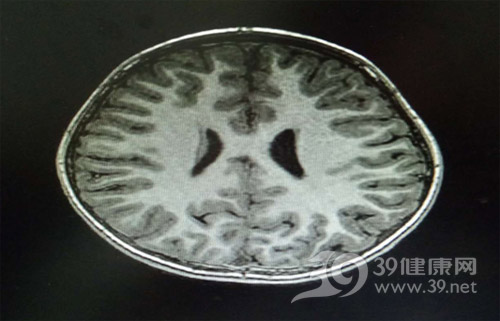 患儿薄层头颅核磁共振扫描：大脑未见结构性异常
