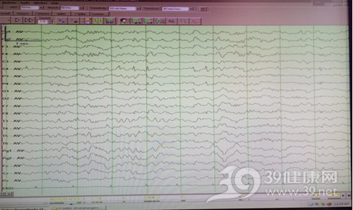 患儿发作间期脑电图：-右侧中央、顶区节律性尖慢波发放