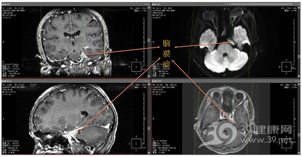 患者头颅MRI提示左侧桥小脑脚区占位病变，考虑脑膜瘤可能