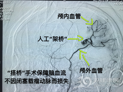 动脉夹层动脉瘤3