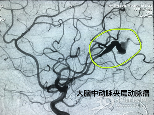 动脉夹层动脉瘤1