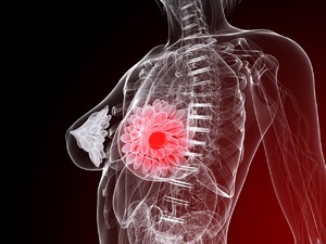 乳腺增生的原因 乳腺增生怎样治疗？