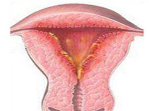得了子宫内膜炎会有什么症状表现？