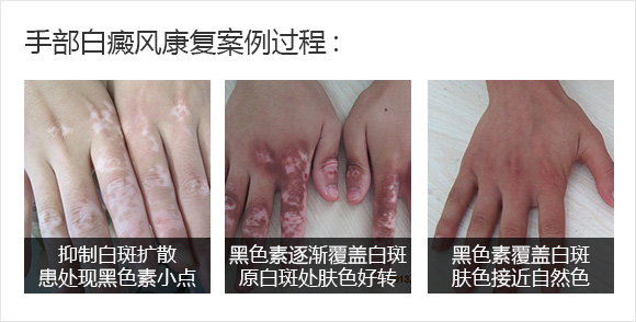 手部康复案例