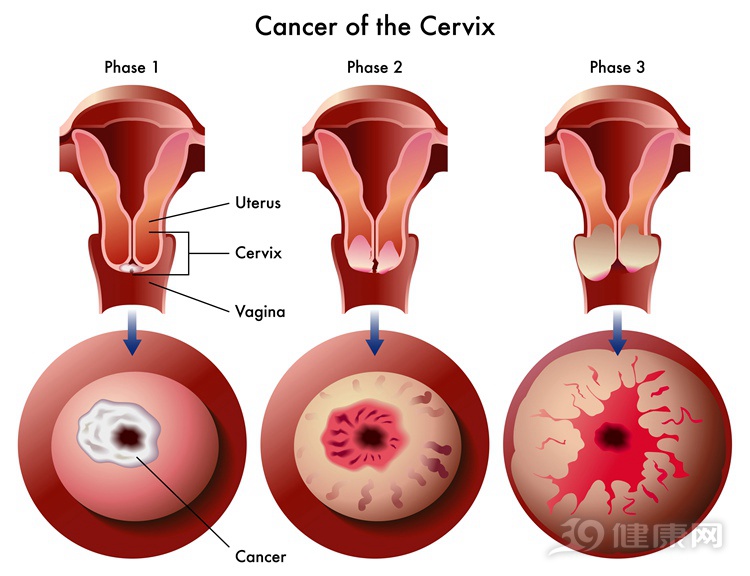 宫颈癌前病变症状图片