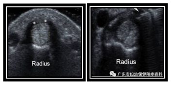 生完孩子手腕疼?专家教你4种锻炼解救“妈妈手”