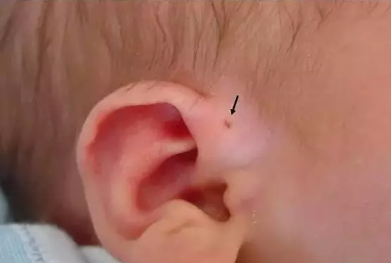 孩子耳朵上有这个小洞，就是“天选之人”了？医生提醒要小心