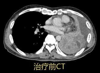 1-治疗前CT2