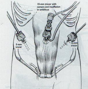 腹腔镜手术孔的位置图图片