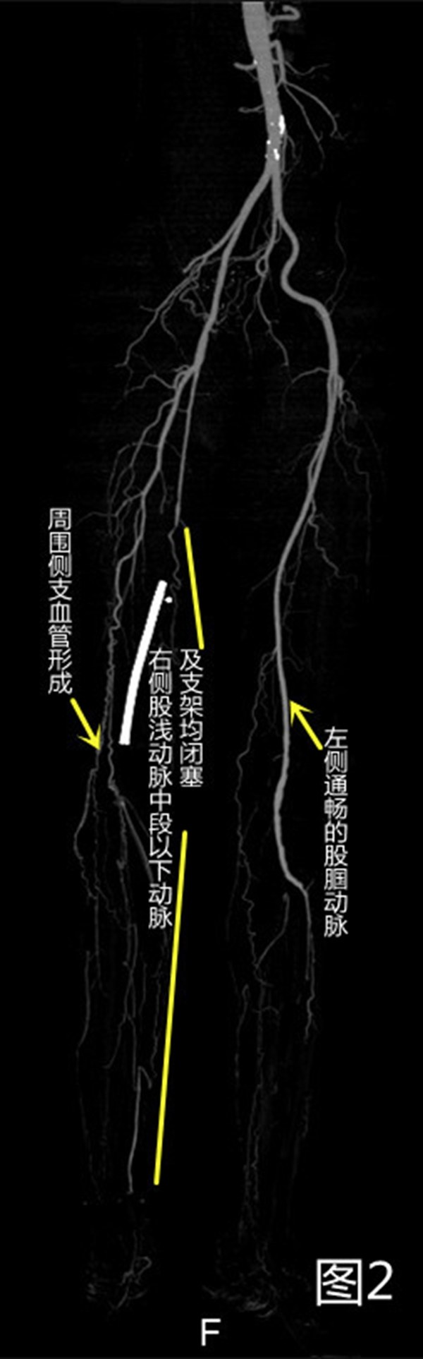“老烟民”下肢疼痛险截肢!医生:这些病兆要当心