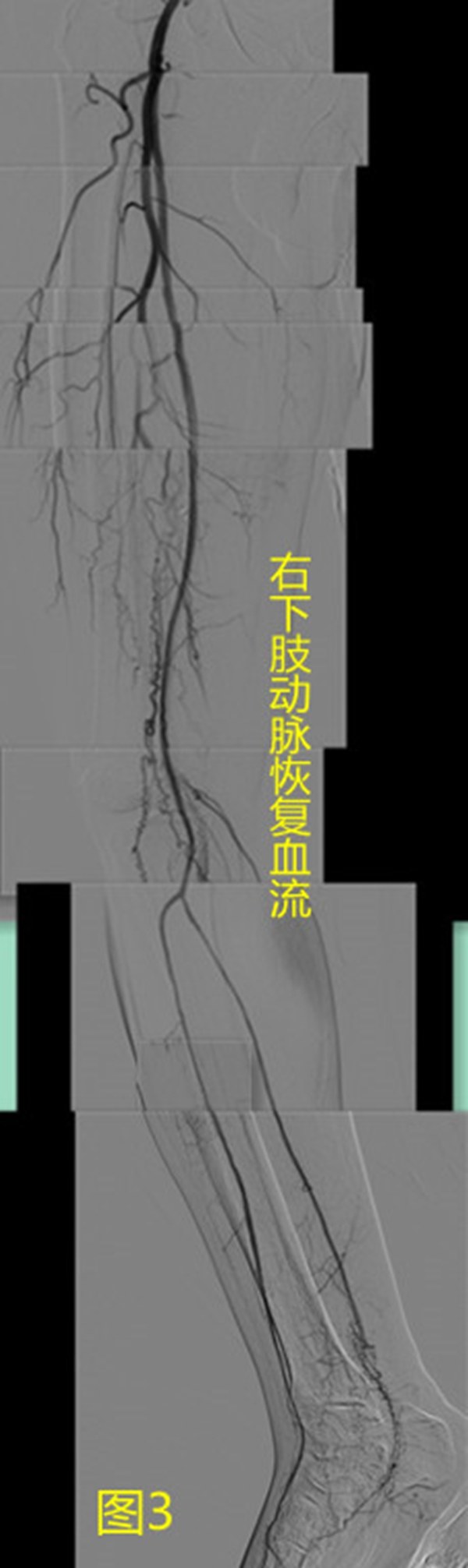 “老烟民”下肢疼痛险截肢!医生:这些病兆要当心