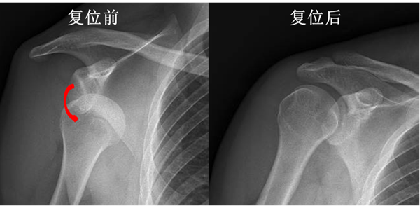 上肢神经容易出现损伤致残?别让肩关节脱位成为“习惯”!