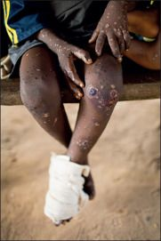 世卫组织发声：猴痘已发生人际传播！这意味着什么？如何预防？