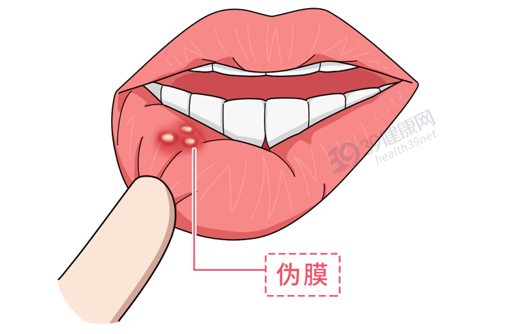 有一种痛叫“口腔溃疡”：只补充维生素不管用，这几种药更靠谱