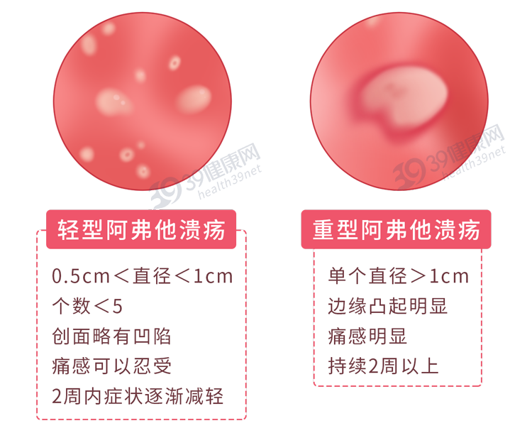 有一种痛叫“口腔溃疡”：只补充维生素不管用，这几种药更靠谱