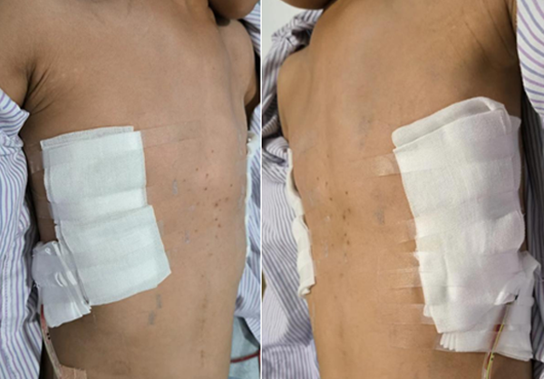 10岁男孩患罕见胸廓畸形医生独创wang手术为他成功矫治