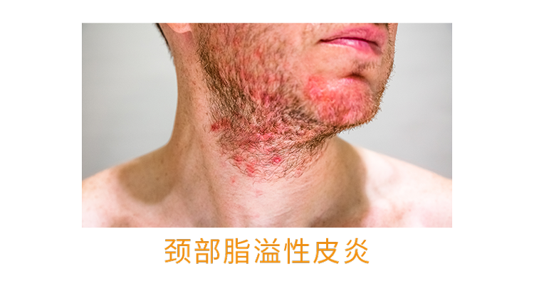 人体缺乏维生素B2,身体3个部位会慢慢“提醒”你,及时补充