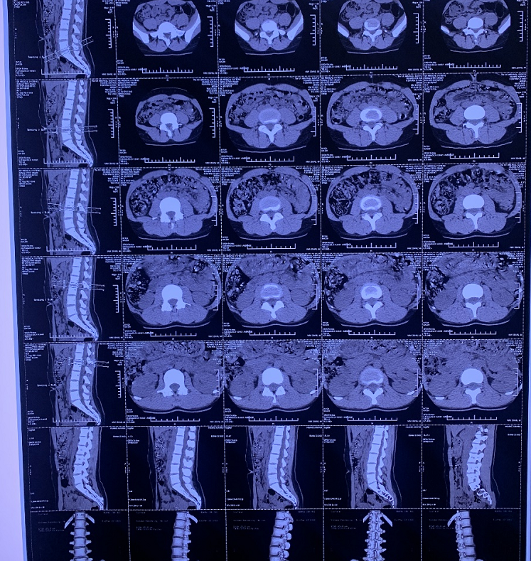 腰椎的ct片子图片图片