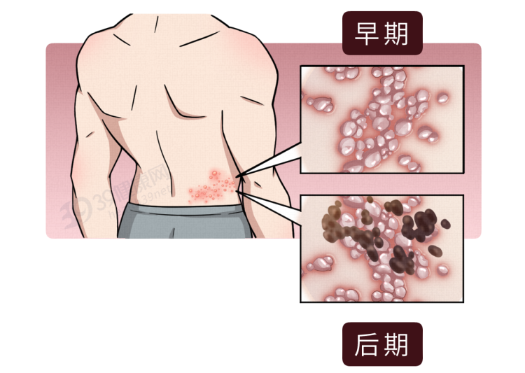 有一种剧痛叫“带状疱疹”，用什么药好得快？教你3招对付它